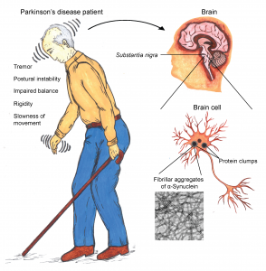 Investigating the mechanism of Parkinson’s disease pathogenesis in test tube