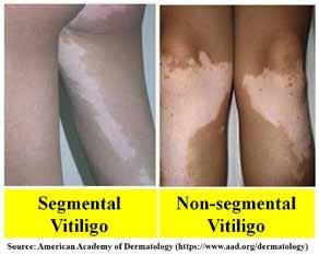 Understanding why vitiligo develops in human skin and finding the effective, affordable and long-lasting treatment