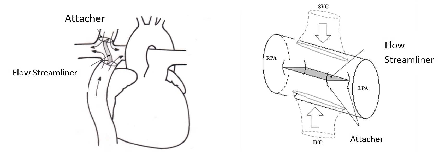  Implantable Cardio-Vascular Flow Streamliner